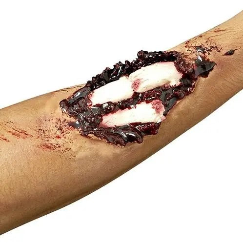 Compound Fracture Application